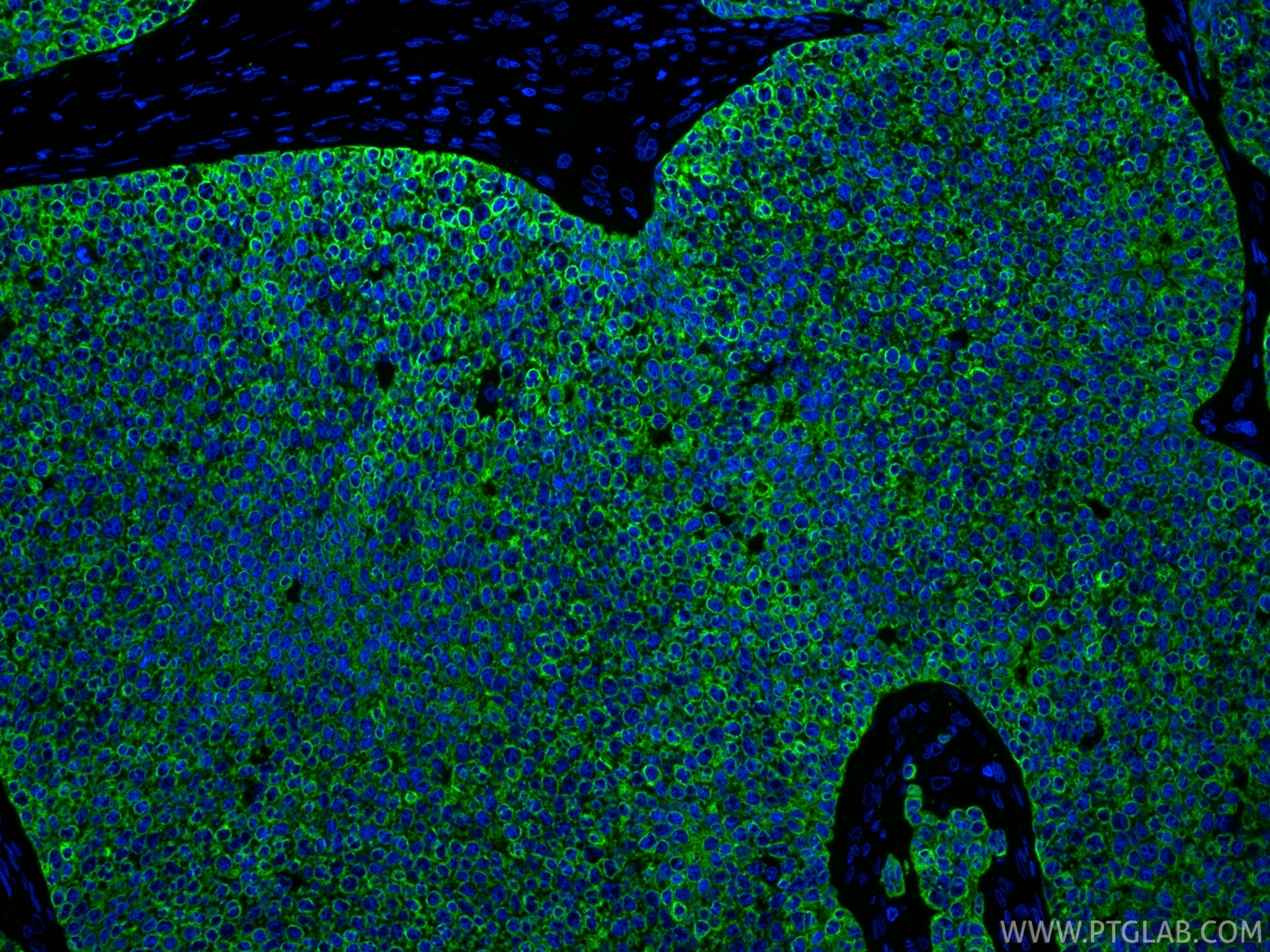 IF Staining of human breast cancer using 29855-1-AP