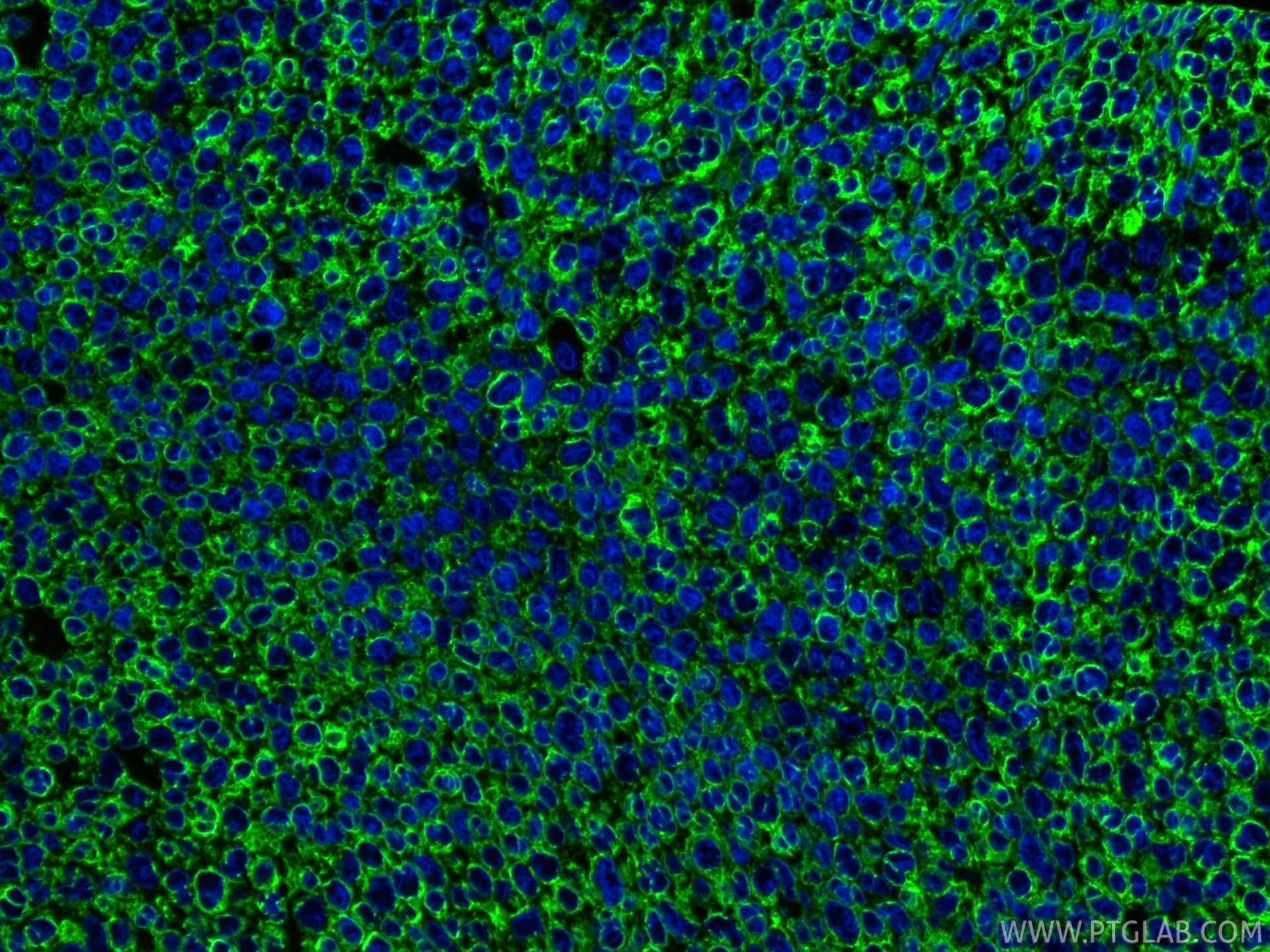 IF Staining of human breast cancer using 29855-1-AP