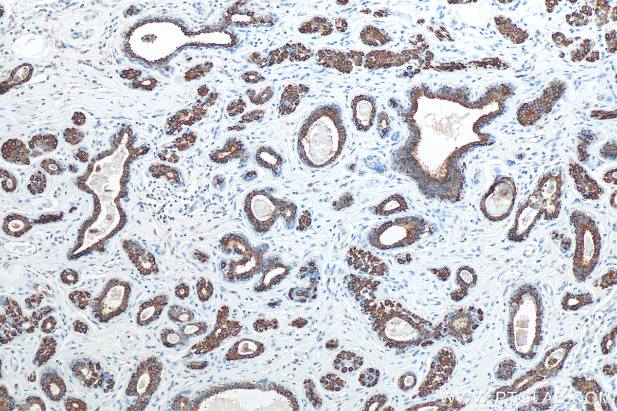 IHC staining of human breast cancer using 29855-1-AP