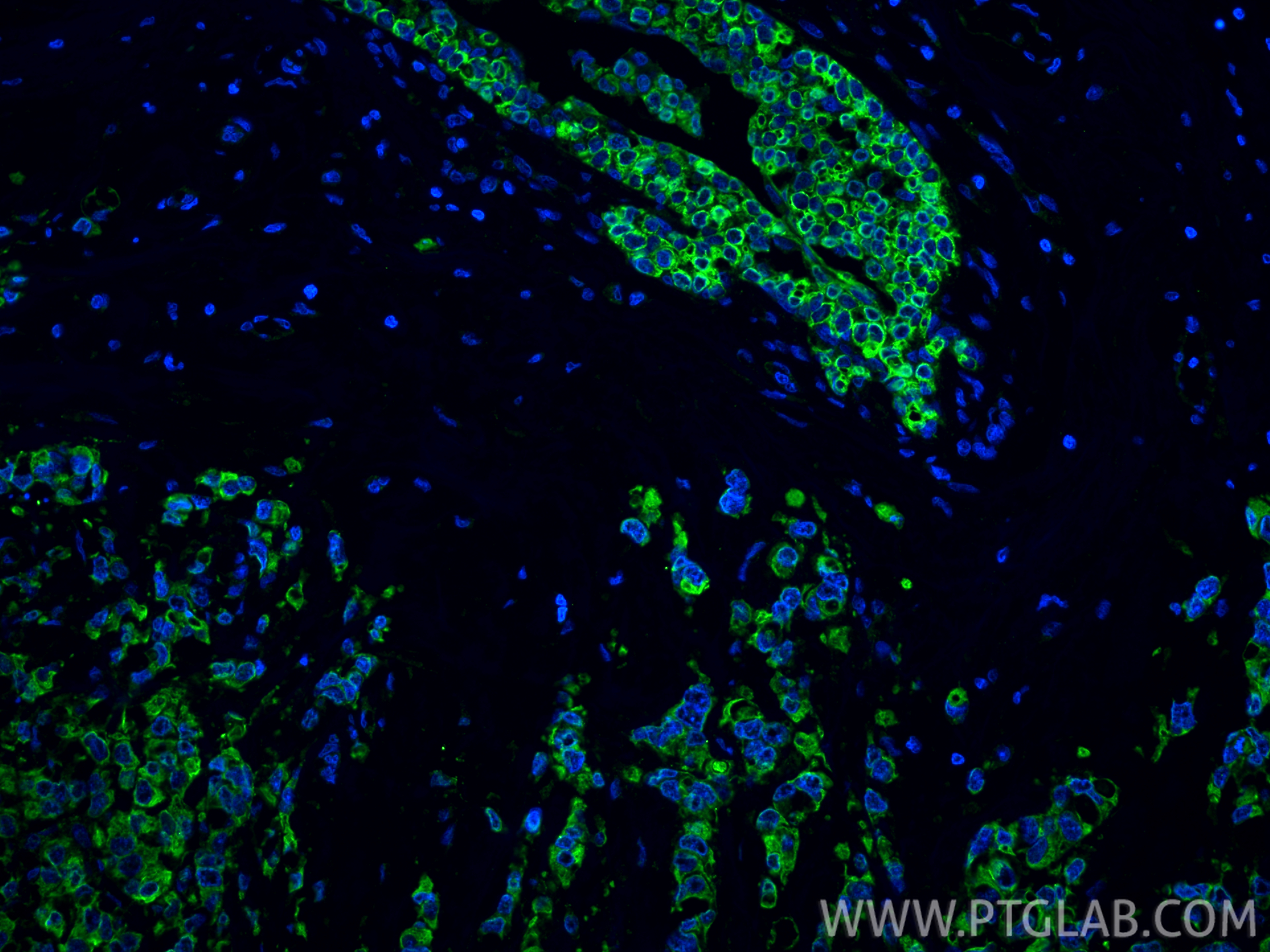 IF Staining of human breast cancer using 86250-1-RR