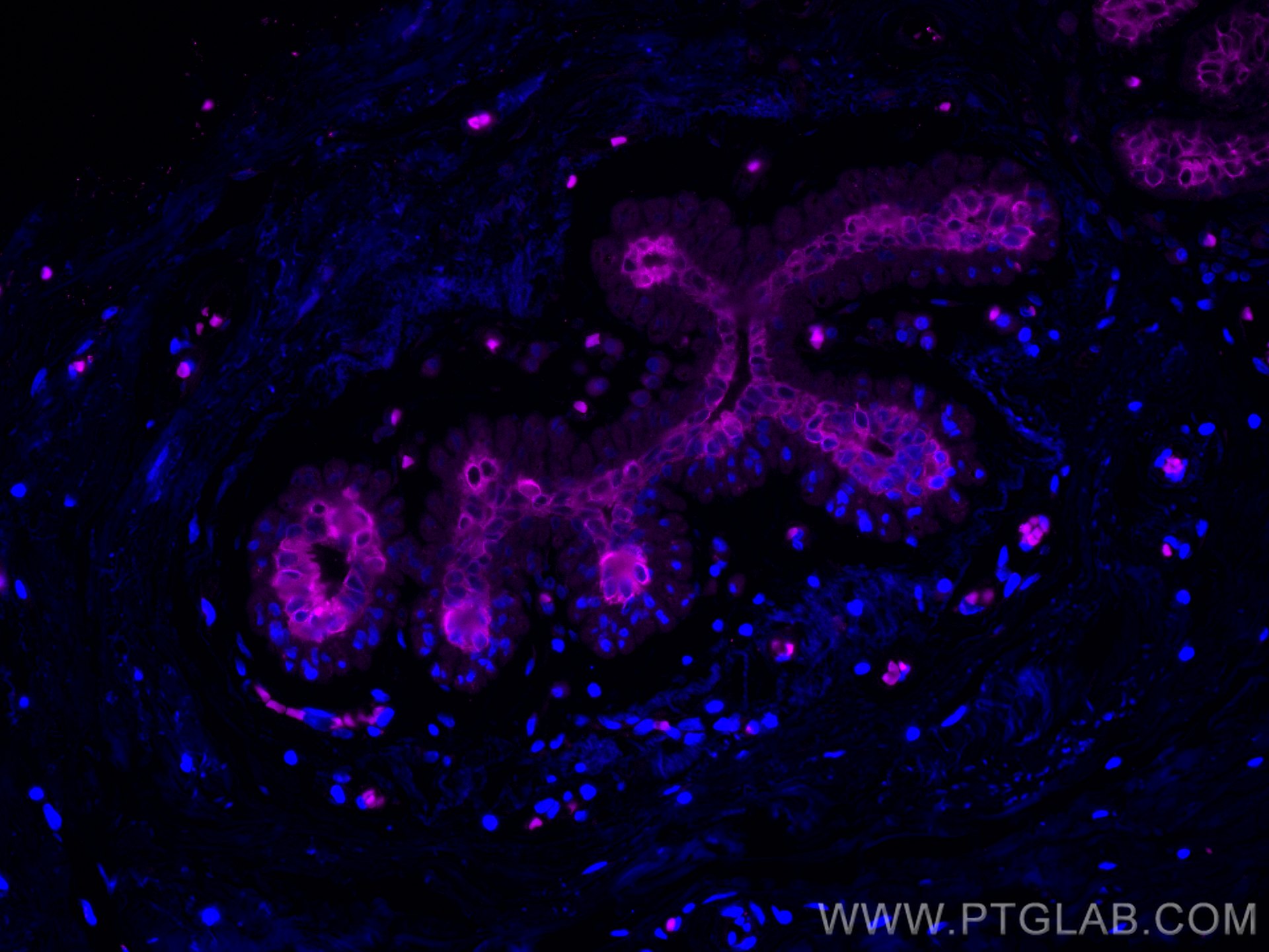 IF Staining of human breast cancer using CL647-60187