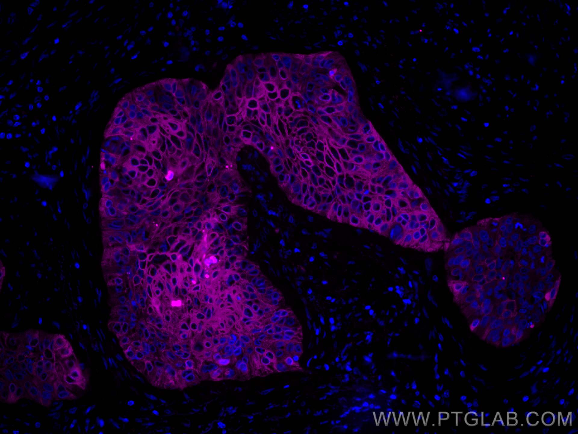 IF Staining of human oesophagus cancer using CL647-60187