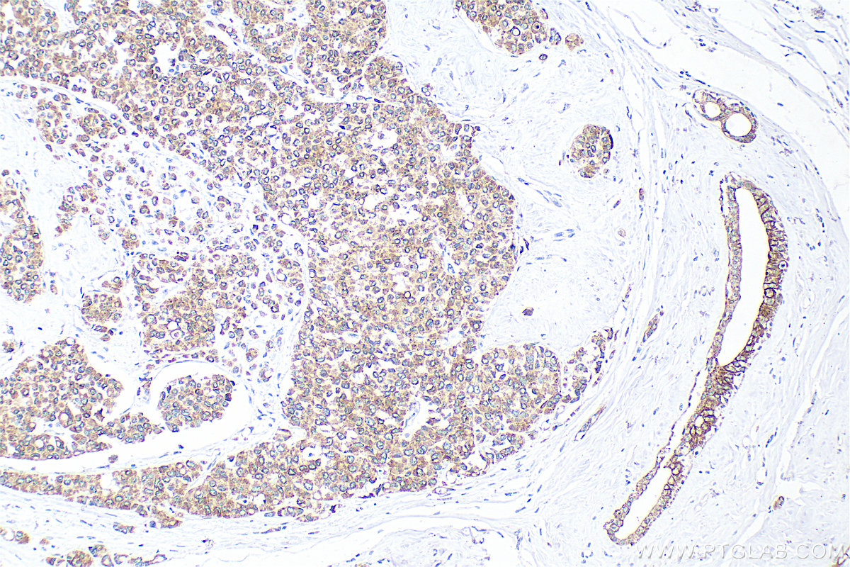 IHC staining of human breast cancer using 33702-1-AP (same clone as 33702-1-PBS)