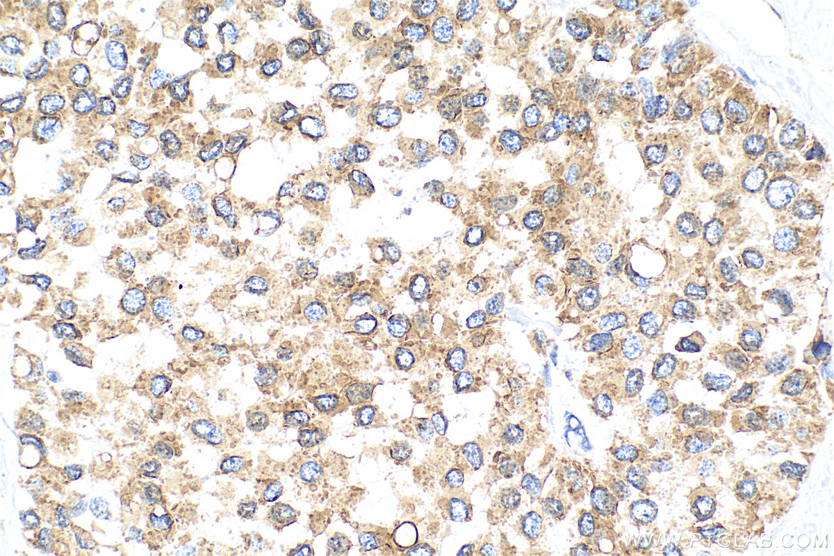 IHC staining of human breast cancer using 33702-1-AP (same clone as 33702-1-PBS)
