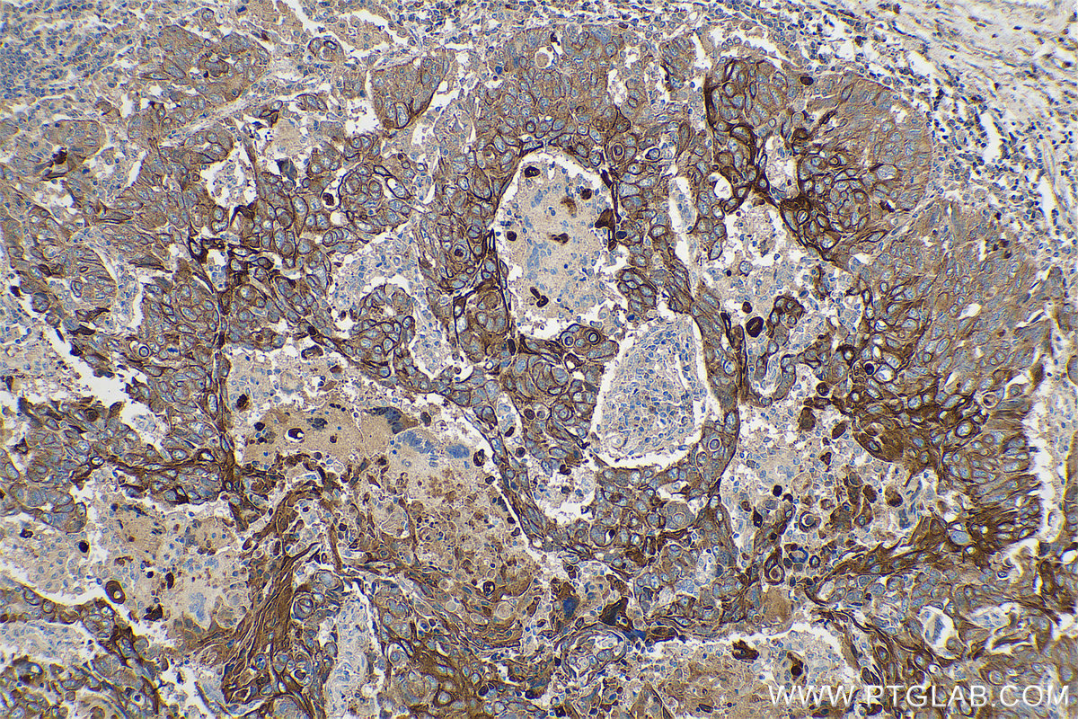 Cytokeratin 5/6