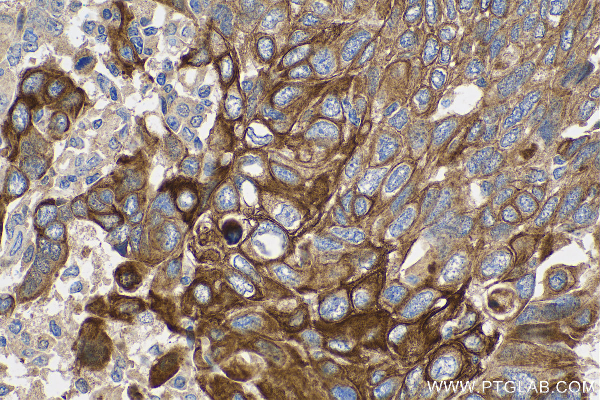 Cytokeratin 5/6