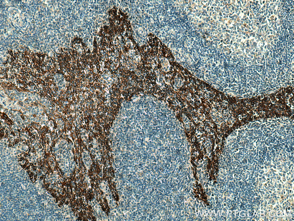 IHC staining of human tonsillitis using 28506-1-AP