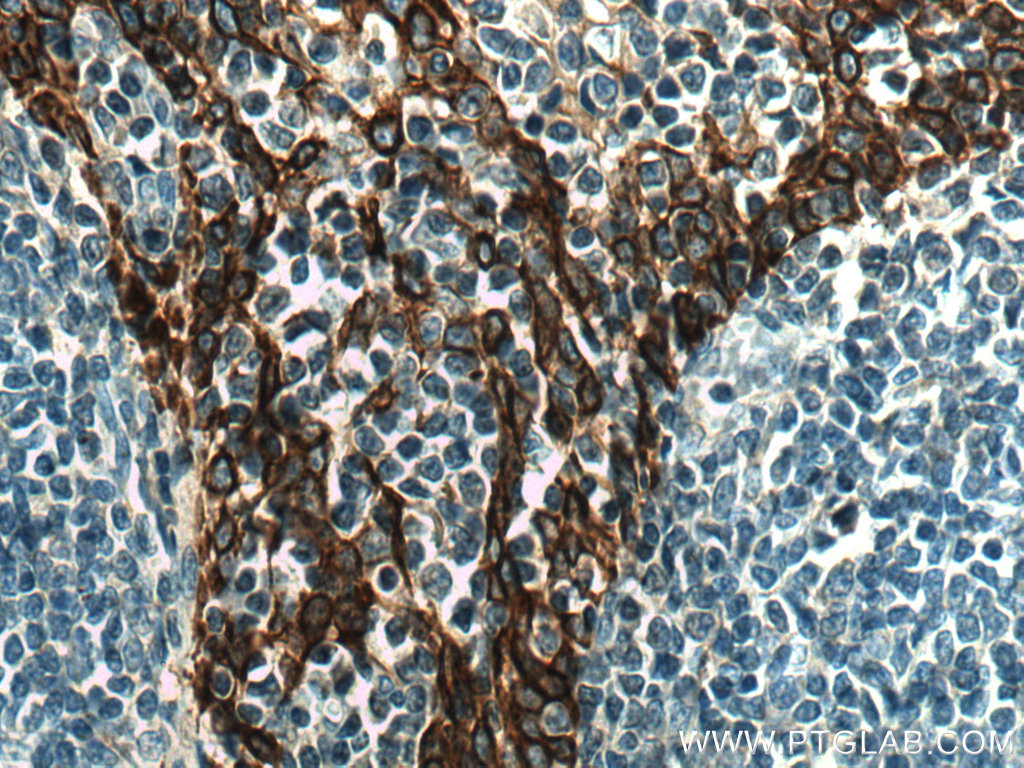 IHC staining of human tonsillitis using 28506-1-AP