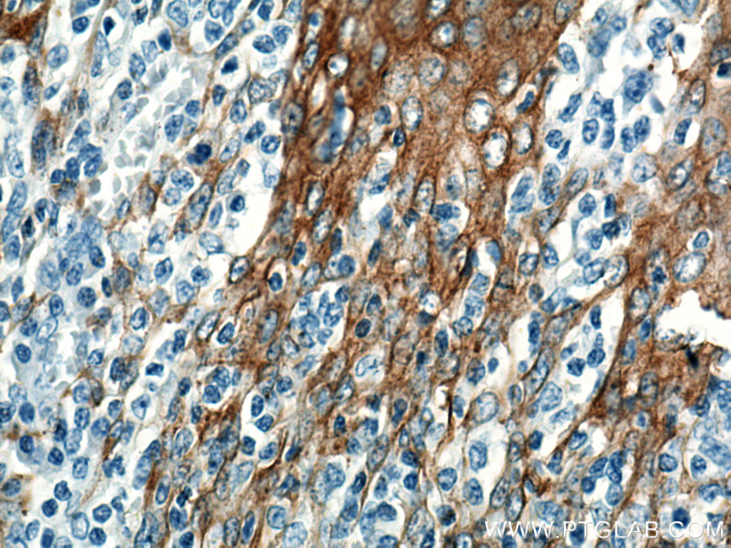 IHC staining of human tonsillitis using 66727-1-Ig