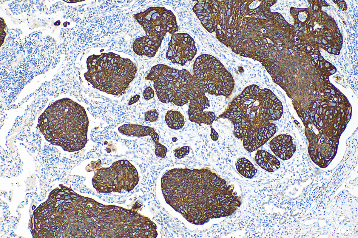 IHC staining of human lung cancer using 82548-7-RR