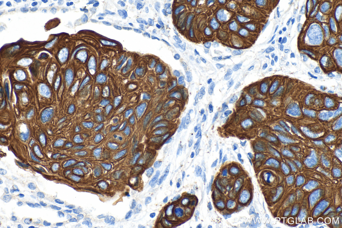 IHC staining of human lung cancer using 82548-7-RR