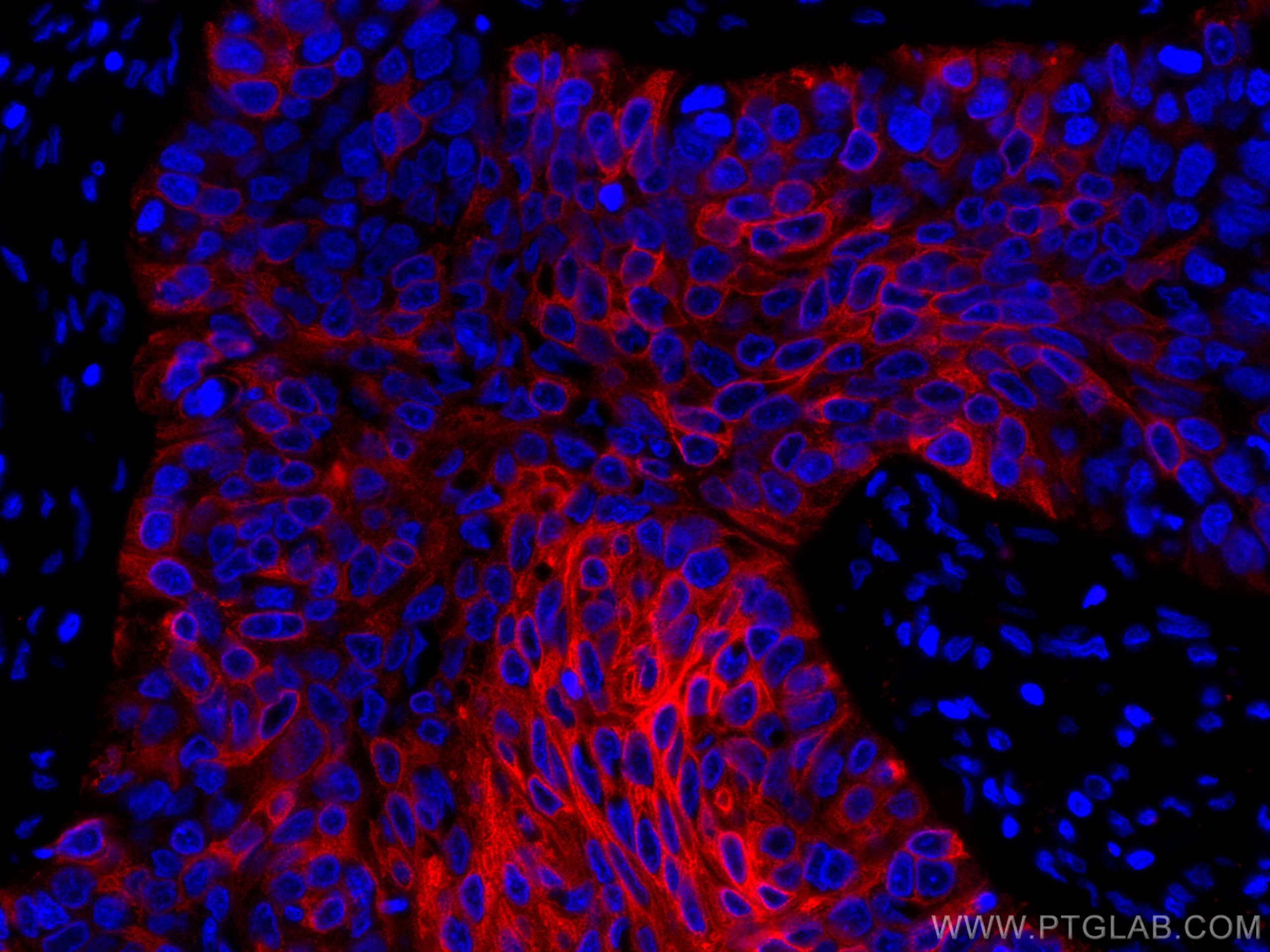 IF Staining of human oesophagus cancer using CL594-66727