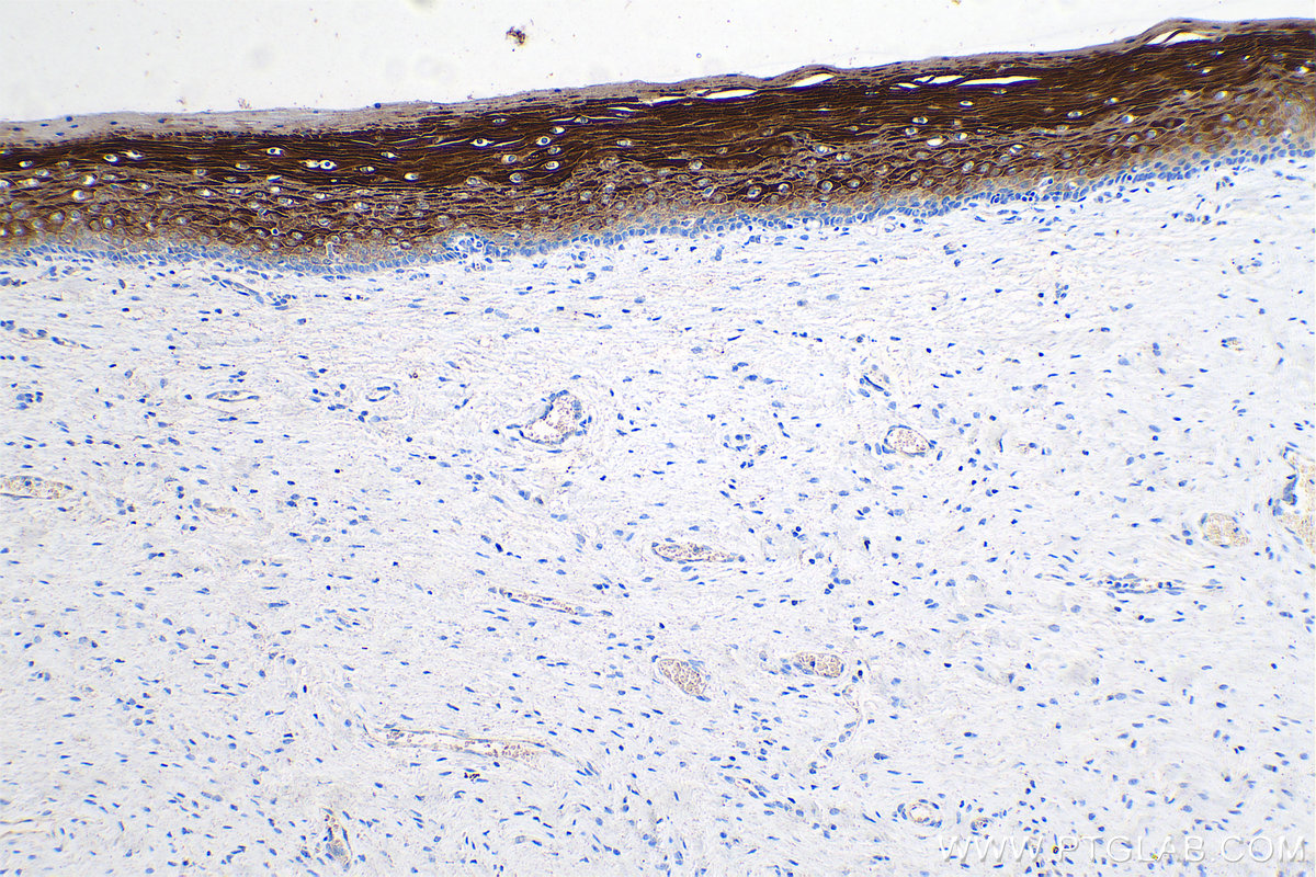 IHC staining of human cervical cancer using 68294-1-Ig (same clone as 68294-1-PBS)
