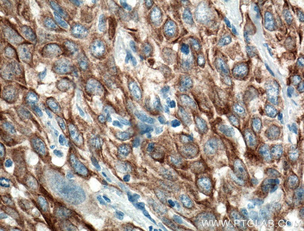 IHC staining of human cervical cancer using 66685-1-Ig