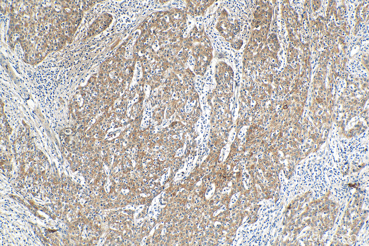 IHC staining of human cervical cancer using 66685-1-Ig (same clone as 66685-1-PBS)