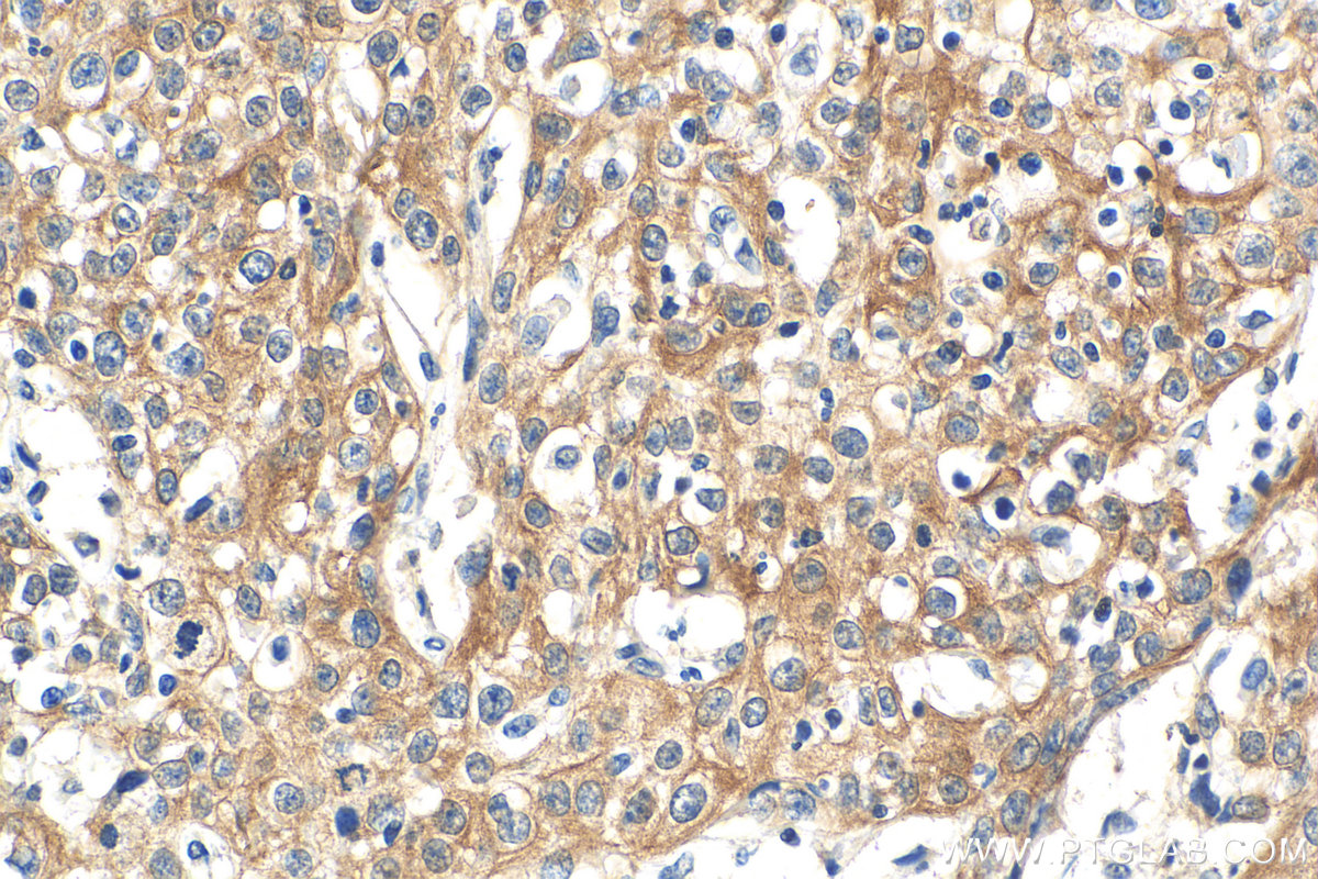 IHC staining of human cervical cancer using 66685-1-Ig (same clone as 66685-1-PBS)