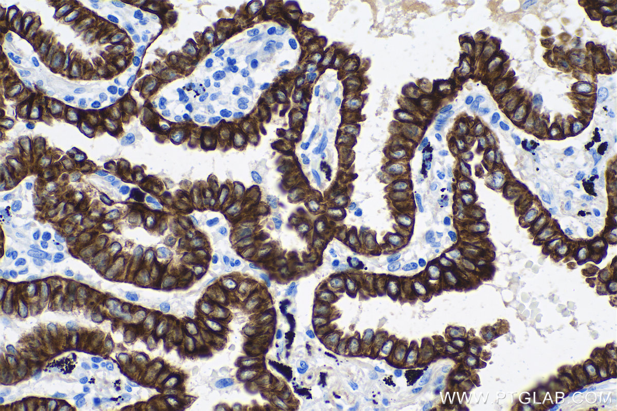 IHC staining of human lung cancer using 68296-1-Ig