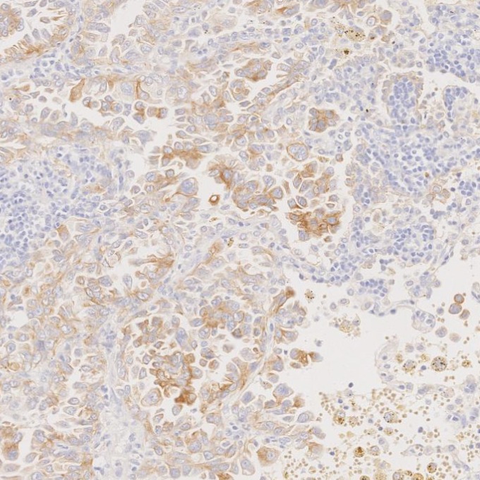 IHC staining of human lung cancer using 68296-1-Ig
