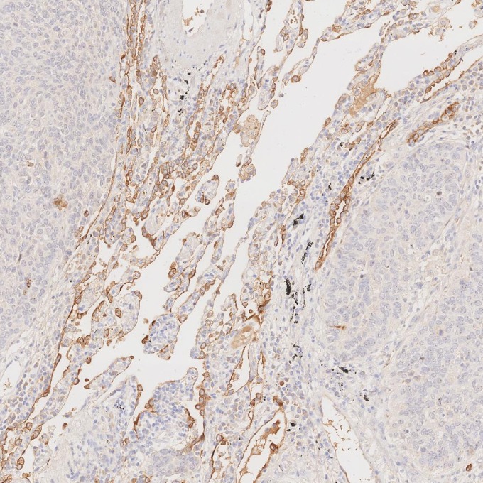 IHC staining of human lung cancer using 68296-1-Ig