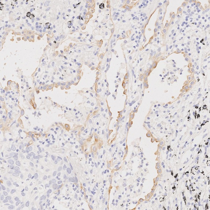 IHC staining of human lung cancer using 68296-1-Ig