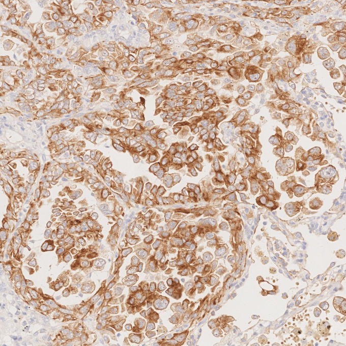 IHC staining of human lung cancer using 68296-1-Ig