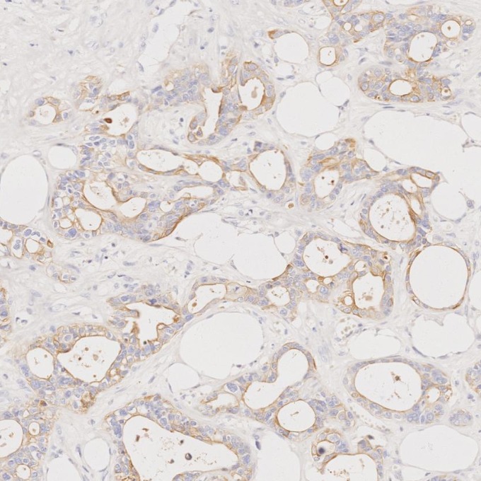 IHC staining of human pancreas cancer using 68296-1-Ig