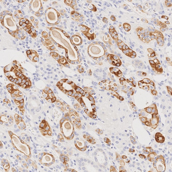 IHC staining of human renal cell carcinoma using 68296-1-Ig
