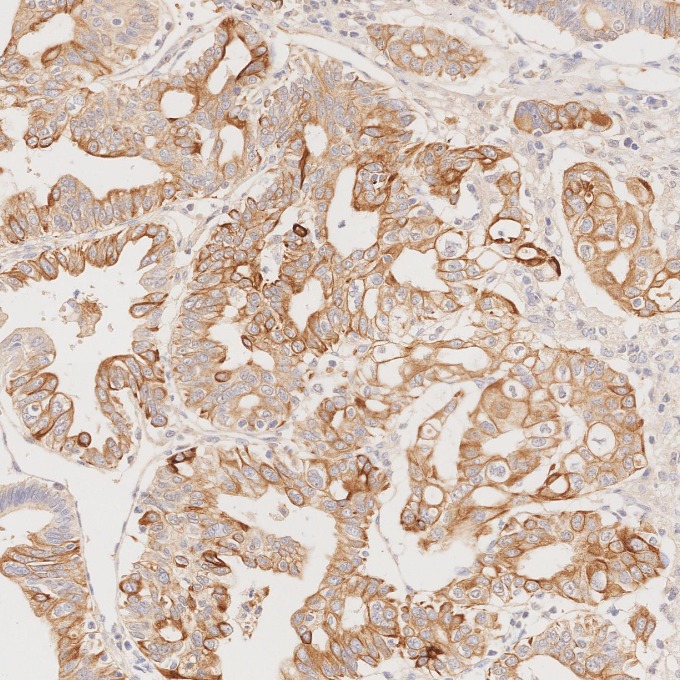 IHC staining of human pancreas cancer using 68296-1-Ig