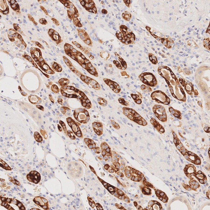 IHC staining of human renal cell carcinoma using 68296-1-Ig