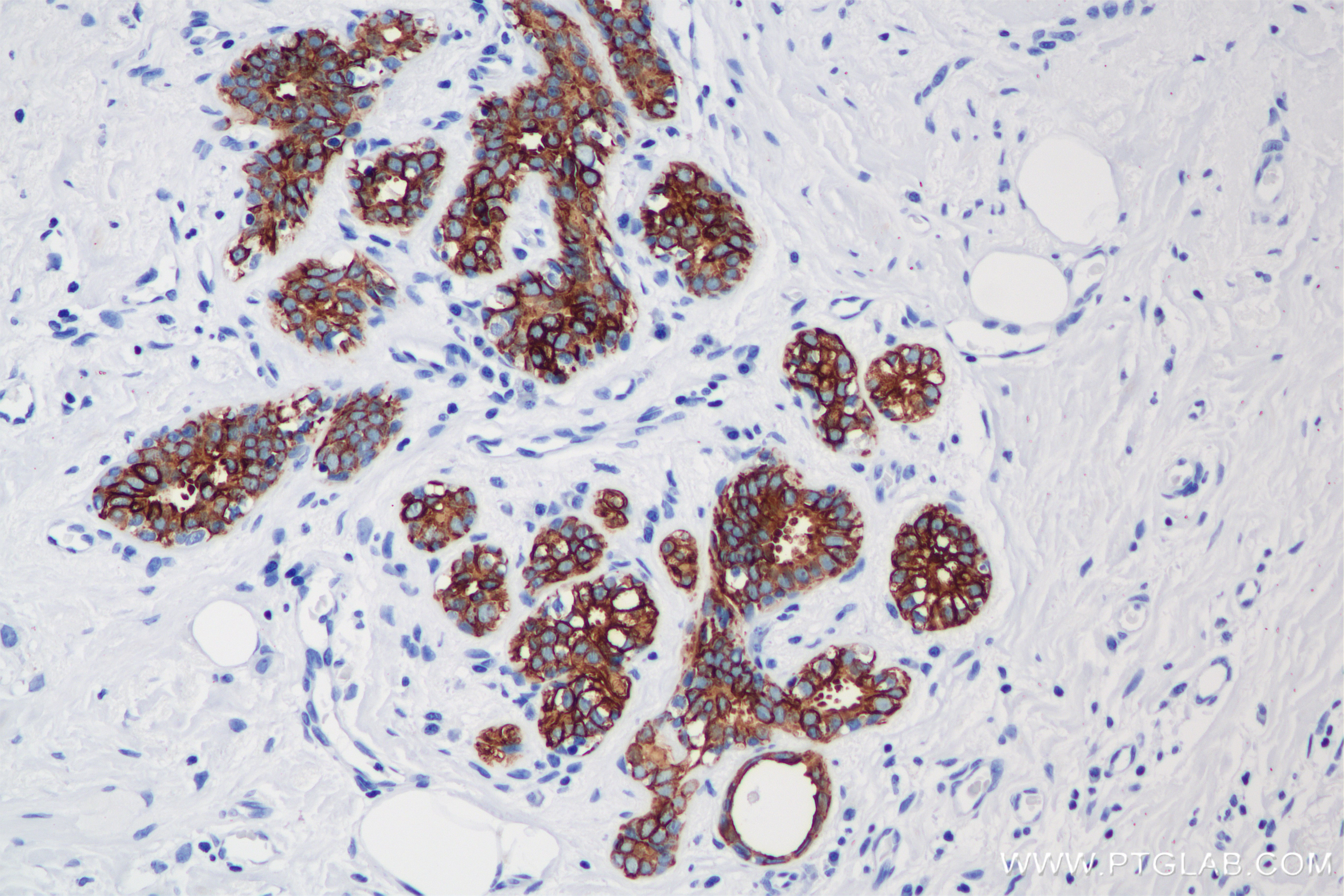 IHC staining of human breast cancer using 86153-7-RR