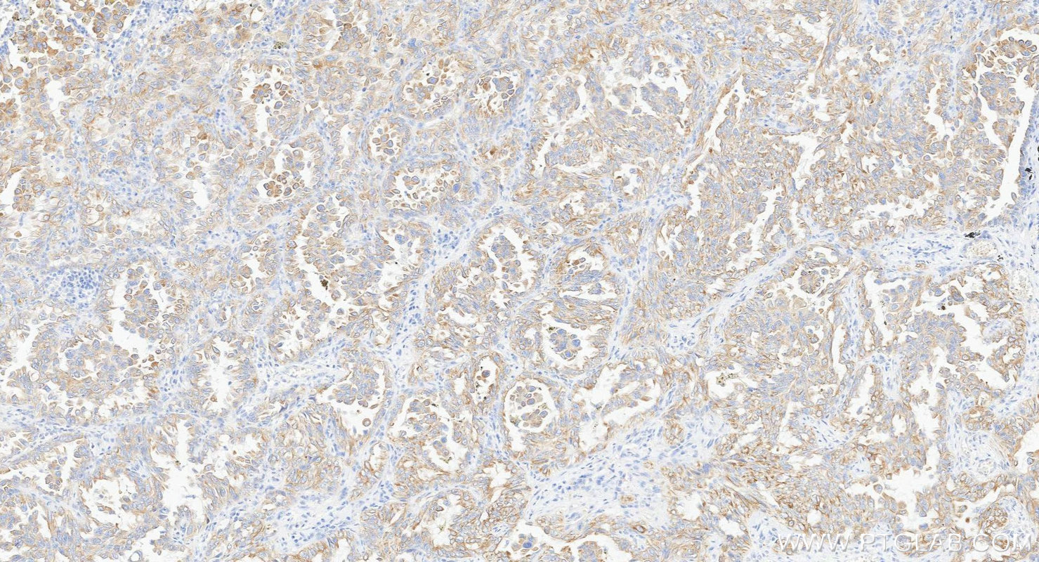 IHC staining of human lung cancer using Biotin-66483 IHC staining of human lung cancer using Biotin-66483