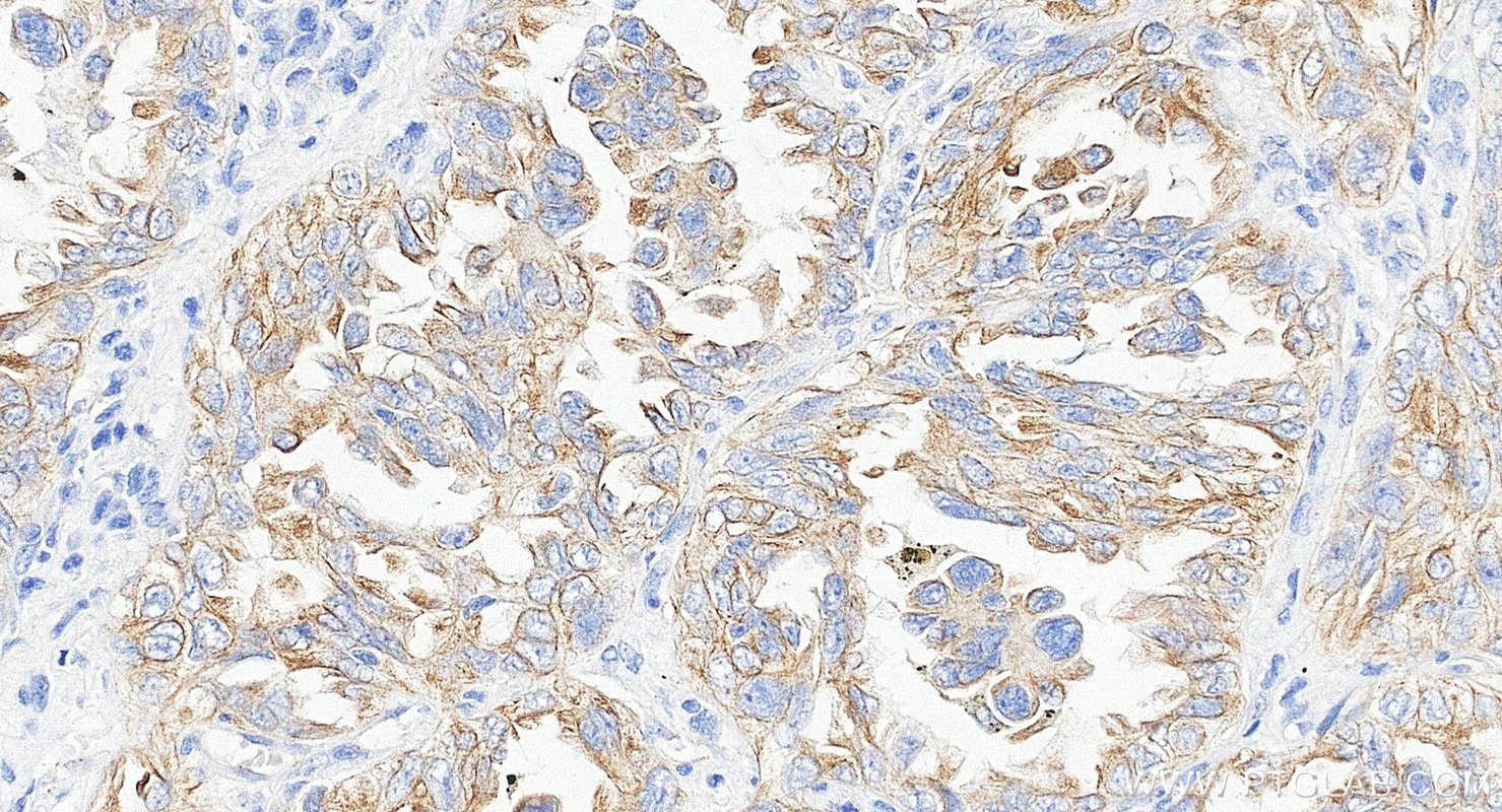 IHC staining of human lung cancer using Biotin-66483 IHC staining of human lung cancer using Biotin-66483