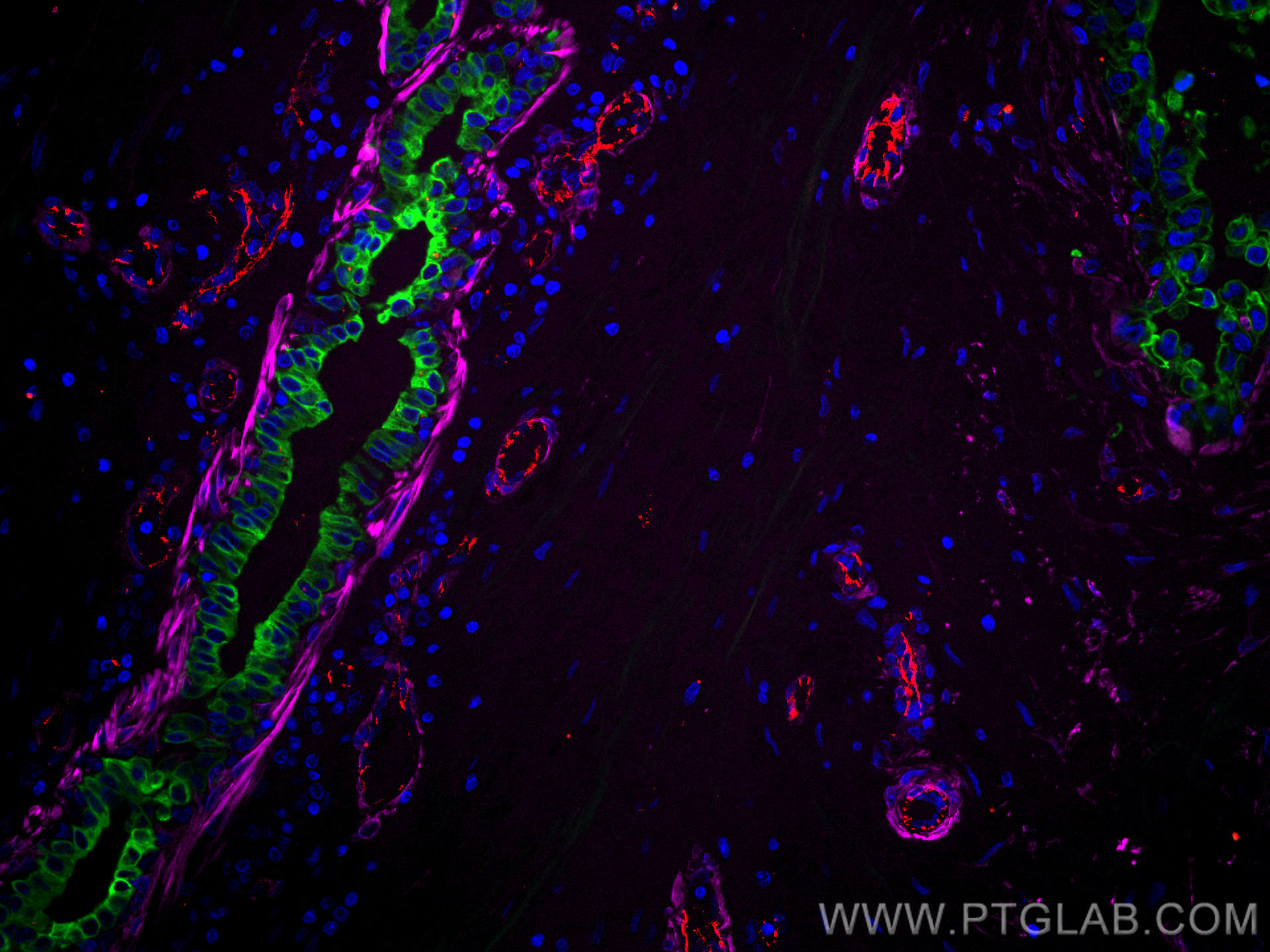 IF Staining of human breast cancer using CL488-15539