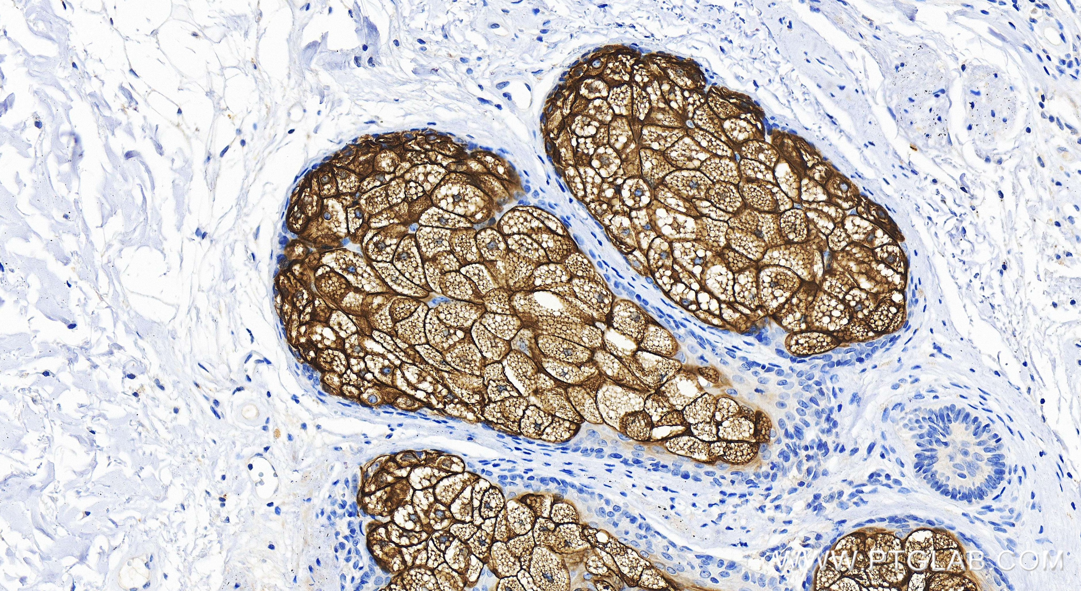 IHC staining of human skin cancer using 86310-1-RR