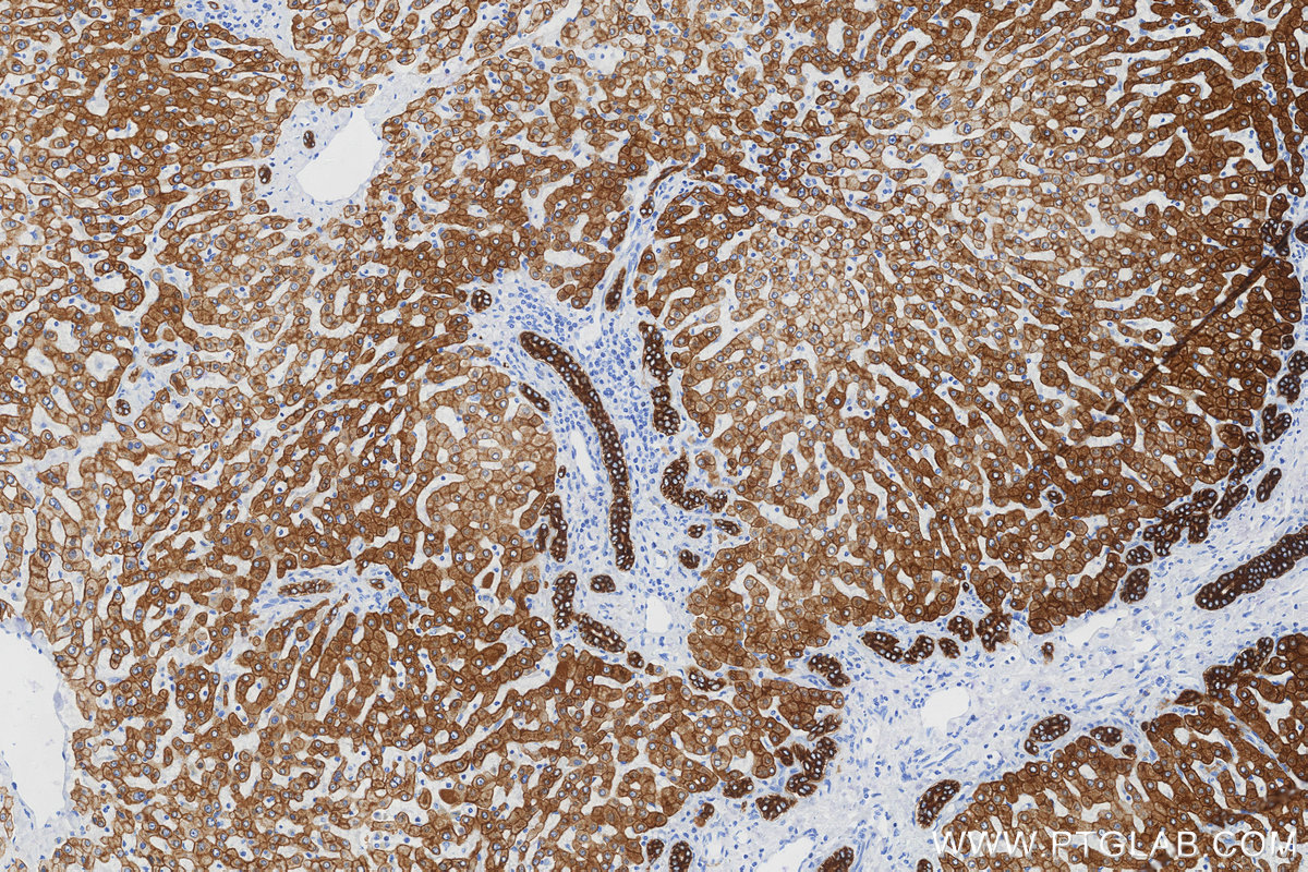 IHC staining of human hepatocirrhosis using 68627-5-Ig