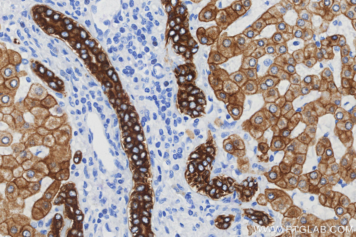IHC staining of human hepatocirrhosis using 68627-5-Ig