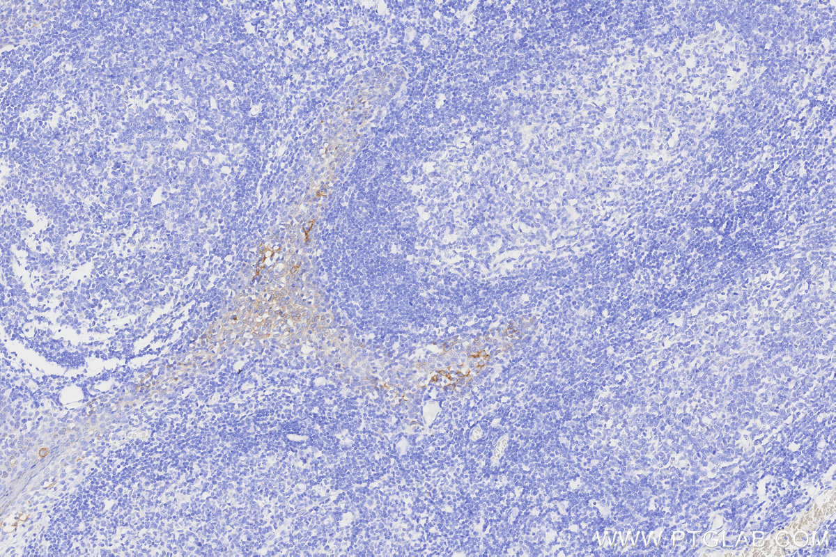 IHC staining of human tonsillitis using 68627-5-Ig