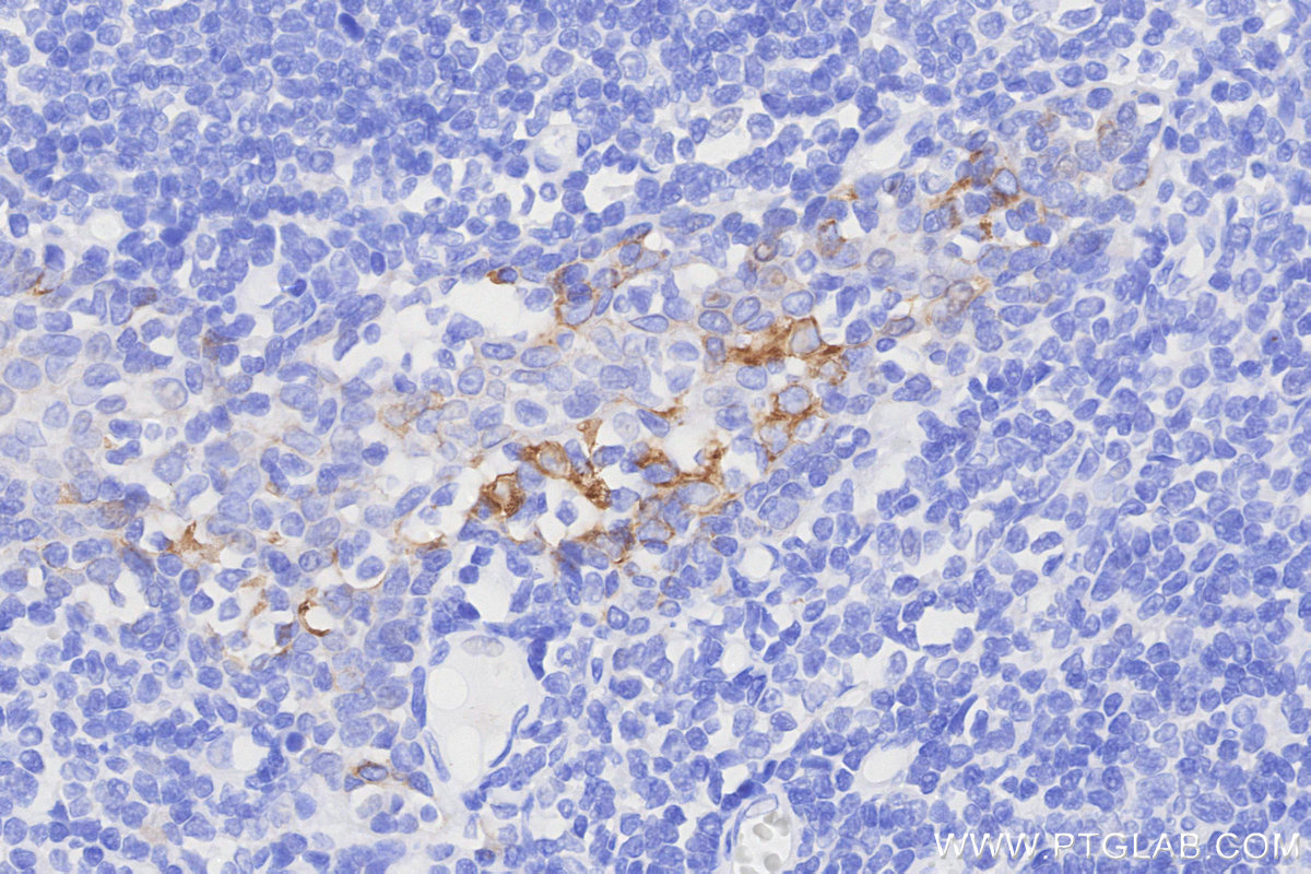 IHC staining of human tonsillitis using 68627-5-Ig