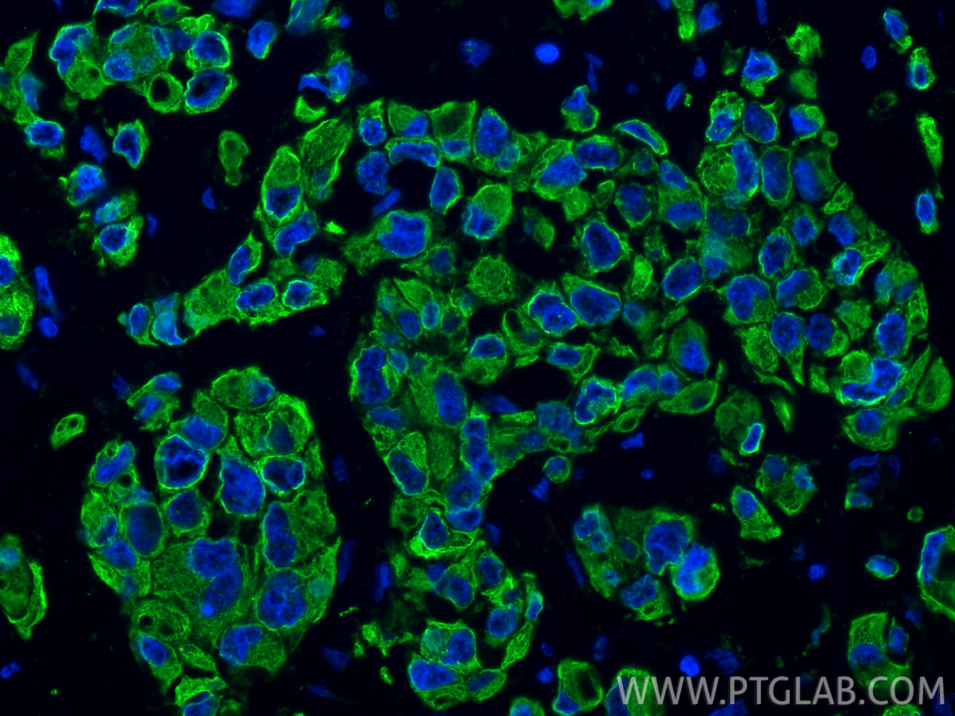 Immunofluorescent analysis of (4% PFA) fixed paraffin-embedded human breast cancer tissue using Cytokeratin 8 antibody (<a class='green' href='/productredirect?CatalogNo=86457-4-RR' target='_blank'>86457-4-RR</a>, Clone: 251045E11 ) at dilution of 1:400 and CoraLite®488-Conjugated Goat Anti-Rabbit IgG(H+L) (<a class='green' href='/productredirect?CatalogNo=SA00013-2' target='_blank'>SA00013-2</a>). Heat mediated antigen retrieval with Tris-EDTA buffer (pH 9.0). This data was developed using the same antibody clone with 86457-4-PBS in a different storage buffer formulation. IF Staining of human breast cancer using 86457-4-RR (same clone as 86457-4-PBS)