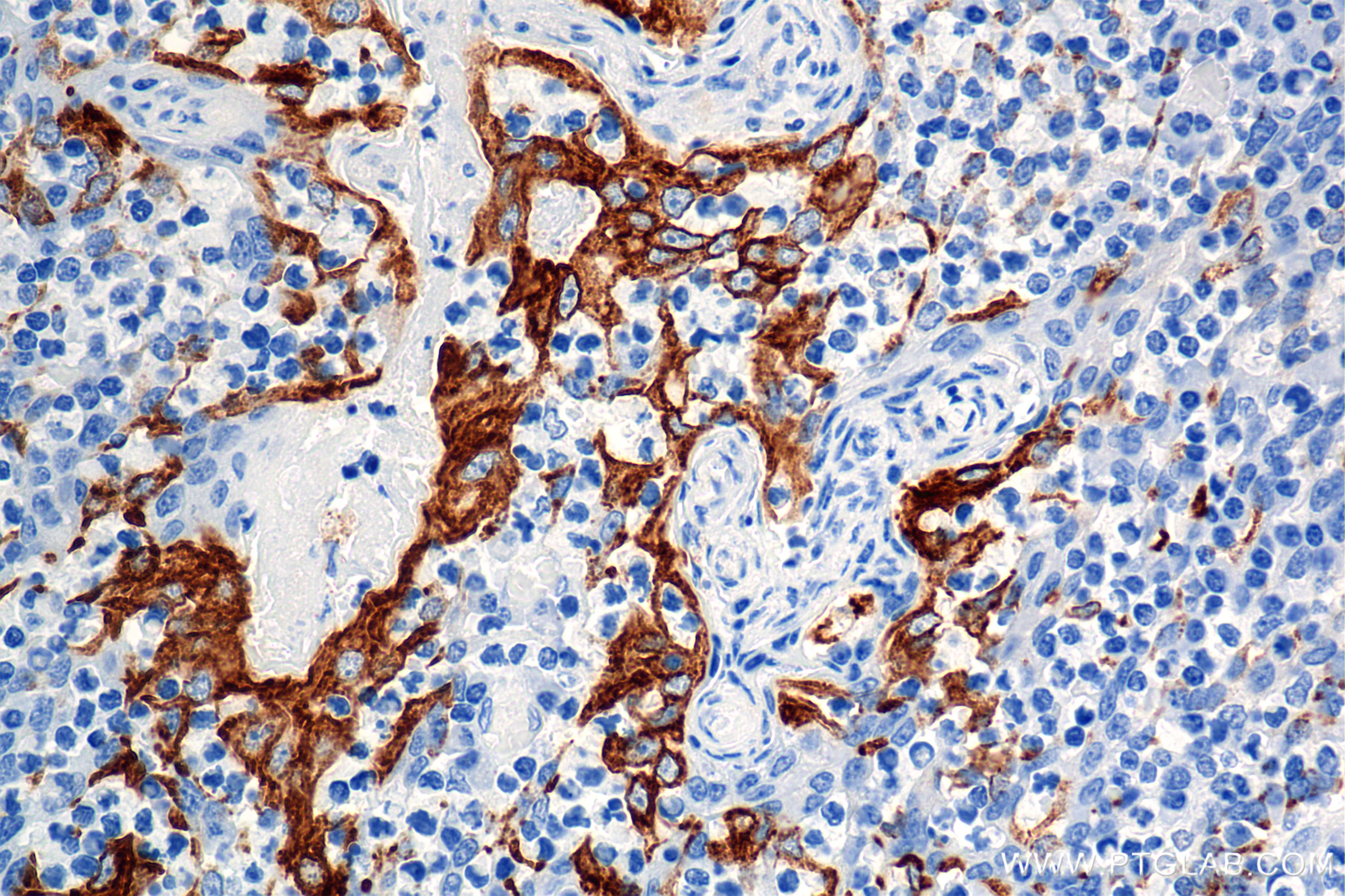 Immunohistochemical analysis of paraffin-embedded human tonsil tissue slide using <a class='green' href='/productredirect?CatalogNo=86457-4-RR' target='_blank'>86457-4-RR</a> (Cytokeratin 8 antibody) at dilution of 1:2000 (under 40x lens). Heat mediated antigen retrieval with Tris-EDTA buffer (pH 9.0). This data was developed using the same antibody clone with 86457-4-PBS in a different storage buffer formulation. IHC staining of human tonsil using 86457-4-RR (same clone as 86457-4-PBS)