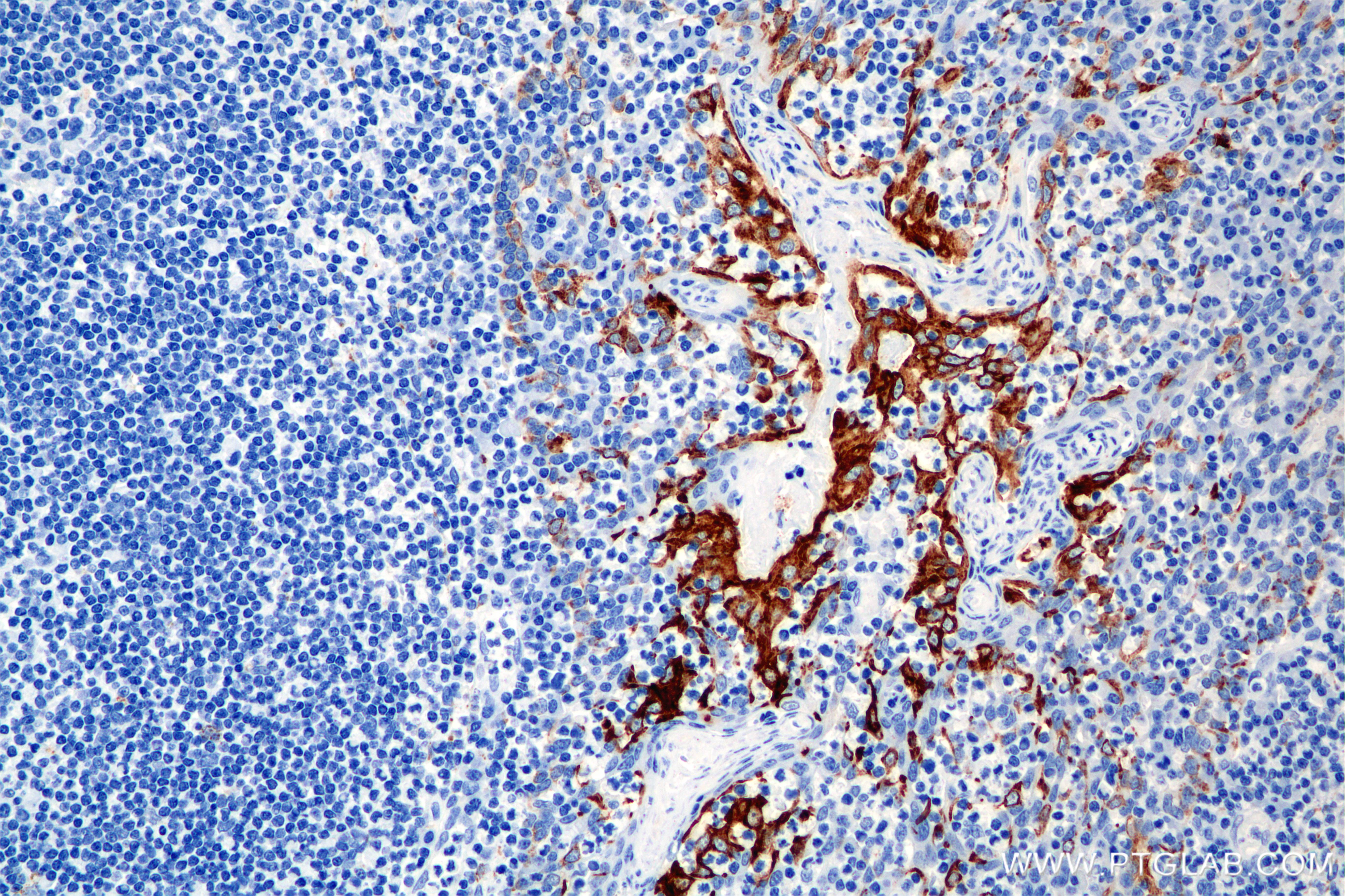 Immunohistochemical analysis of paraffin-embedded human tonsil tissue slide using <a class='green' href='/productredirect?CatalogNo=86457-4-RR' target='_blank'>86457-4-RR</a> (Cytokeratin 8 antibody) at dilution of 1:2000 (under 20x lens). Heat mediated antigen retrieval with Tris-EDTA buffer (pH 9.0). This data was developed using the same antibody clone with 86457-4-PBS in a different storage buffer formulation. IHC staining of human tonsil using 86457-4-RR (same clone as 86457-4-PBS)
