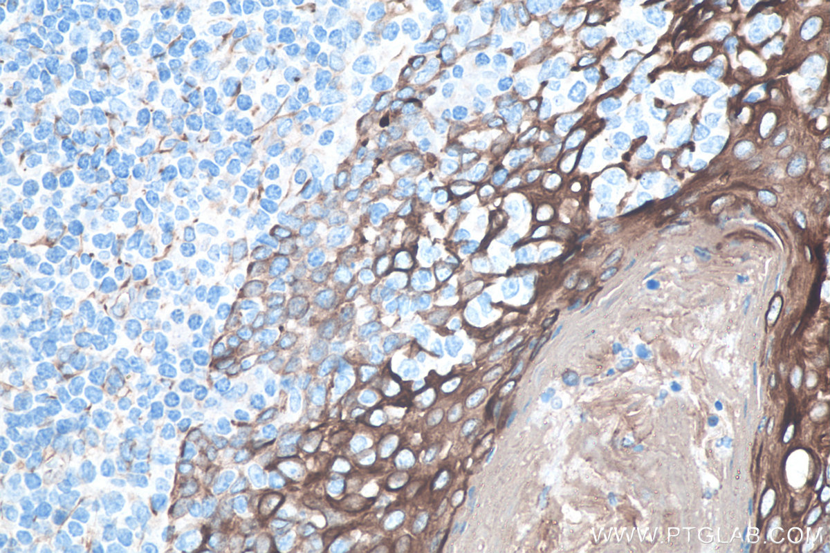 IHC staining of human tonsillitis using 27105-1-AP