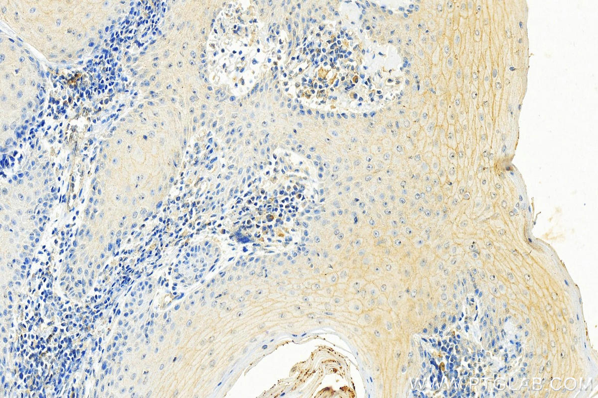 IHC staining of human skin cancer using 67287-1-Ig (same clone as 67287-1-PBS)