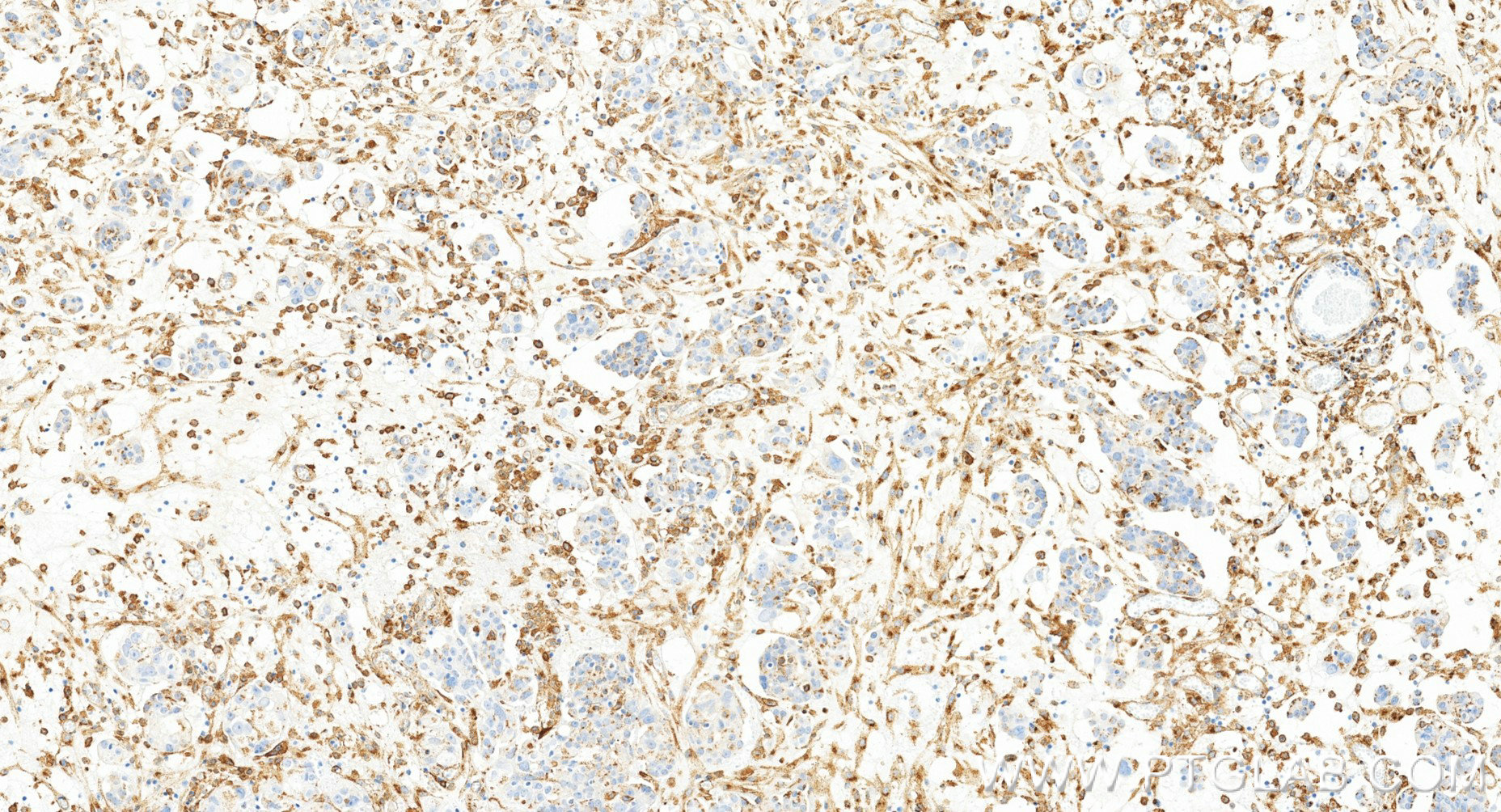 IHC staining of human ovary cancer using 86141-1-RR (same clone as 86141-1-PBS) IHC staining of human ovary cancer using 86141-1-RR (same clone as 86141-1-PBS)