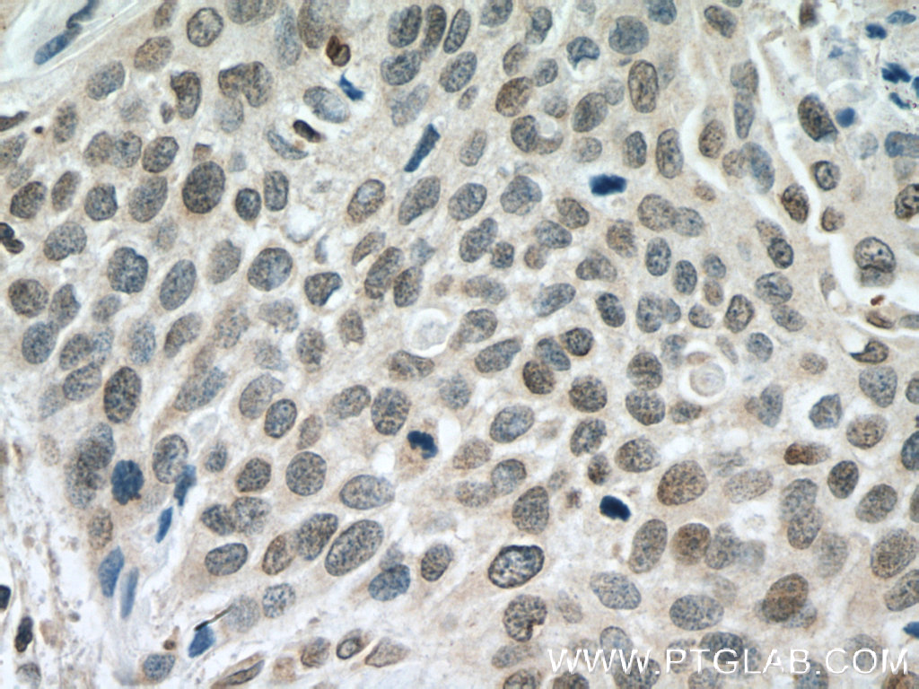 IHC staining of human oesophagus cancer using 10914-1-AP