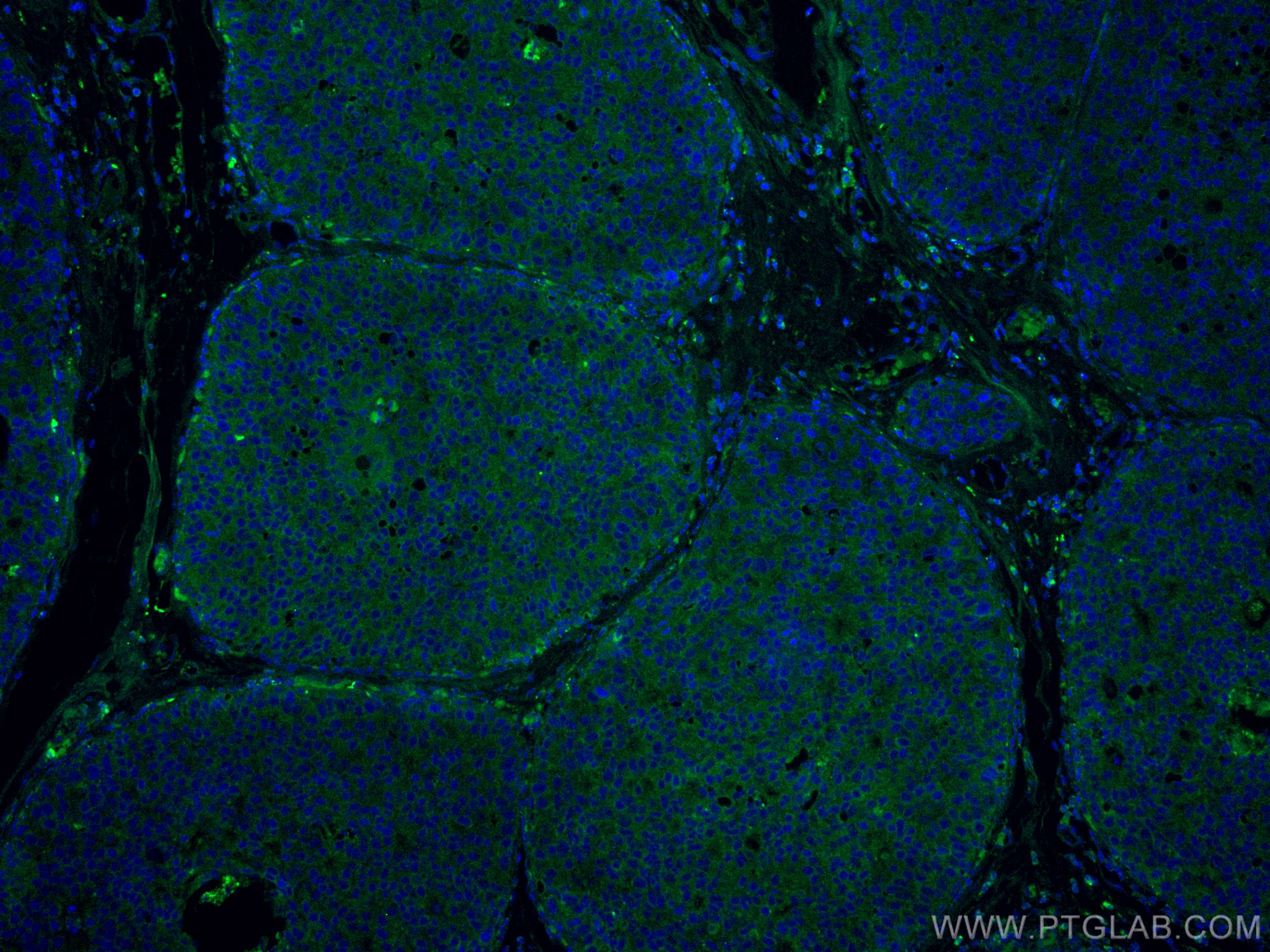 IF Staining of human breast cancer using CL488-67815