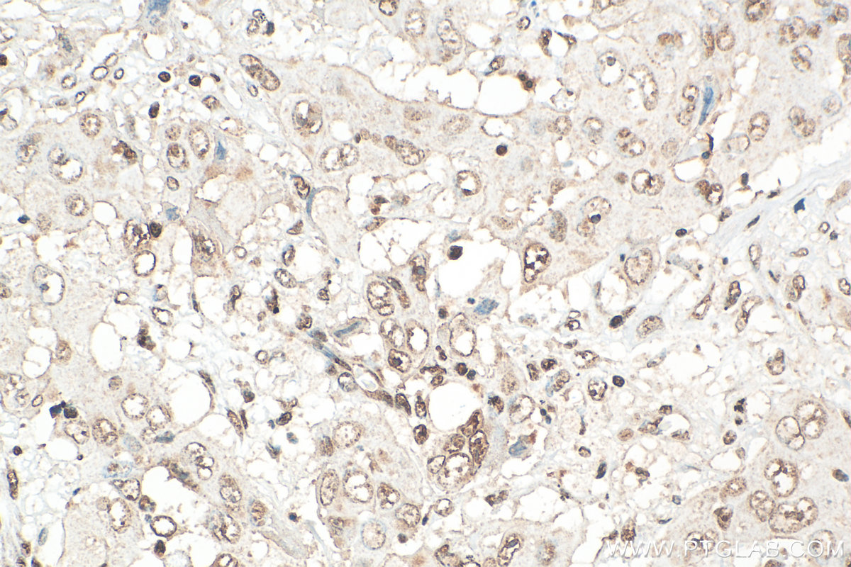 IHC staining of human lung cancer using 30656-1-AP