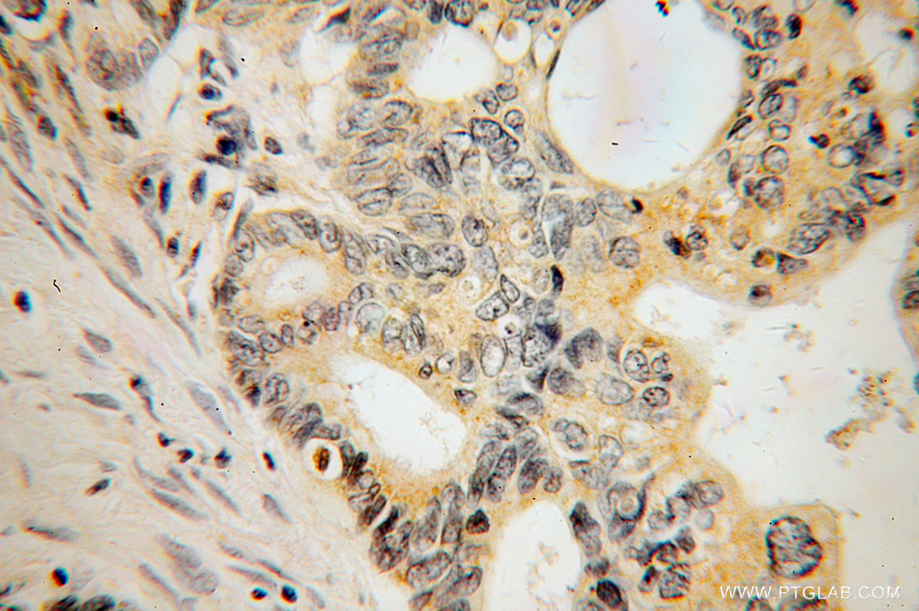 IHC staining of human liver cancer using 14722-1-AP