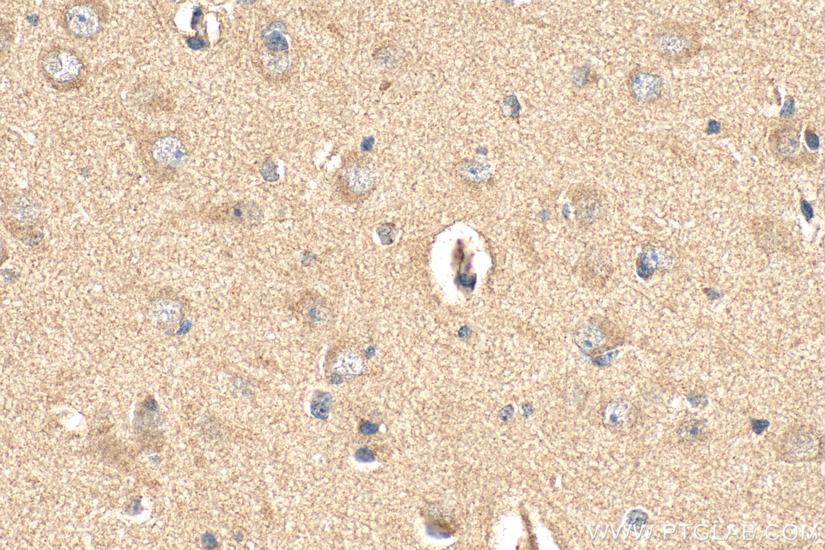 Immunohistochemical analysis of paraffin-embedded human gliomas tissue slide using RMX00040 (DARS2 antibody) at dilution of 1:200 (under 40x lens). Heat mediated antigen retrieval with Tris-EDTA buffer (pH 9.0). IHC staining of human gliomas using RMX00040
