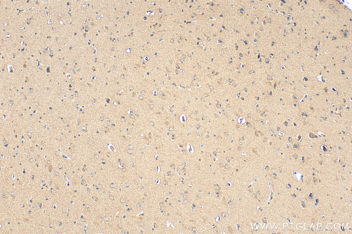 Immunohistochemical analysis of paraffin-embedded human gliomas tissue slide using RMX00040 (DARS2 antibody) at dilution of 1:200 (under 10x lens). Heat mediated antigen retrieval with Tris-EDTA buffer (pH 9.0). IHC staining of human gliomas using RMX00040